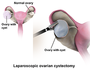 Hysterectomy