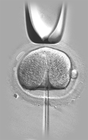 Intracytoplasmic Sperm Injection