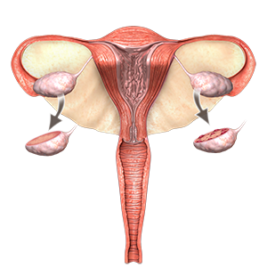 Polycystic Ovarian Syndrome